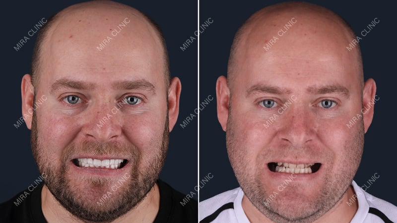 Before and after full mouth restoration